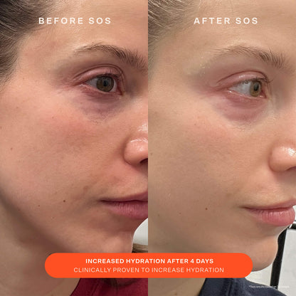 [Shared: A comparison before and after the use of Tower 28 Beauty SOS Recovery Cream. "Increased hydration after 4 days. Clinically proven to increase hydration."]