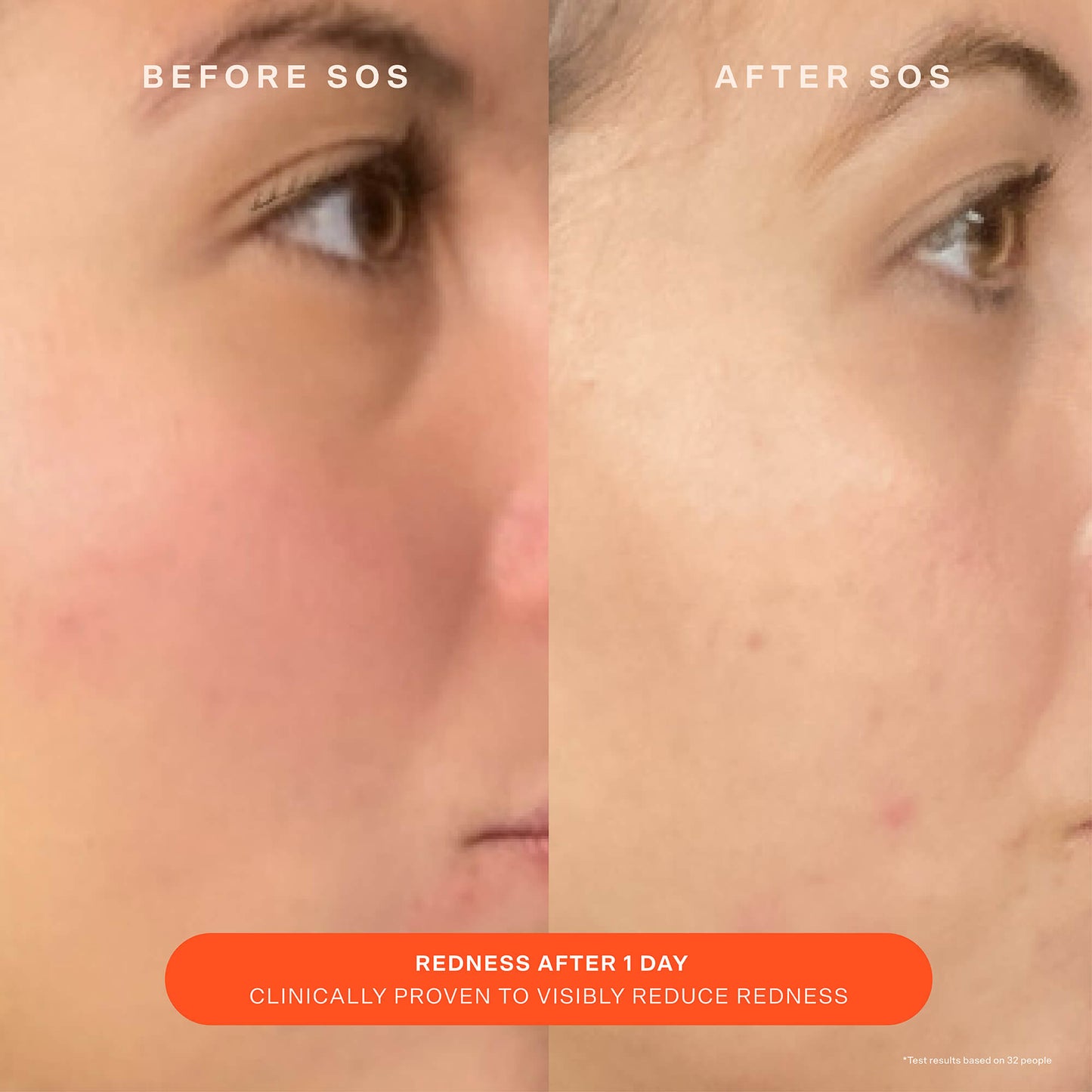 [Shared: A comparison before and after the use of Tower 28 Beauty SOS Recovery Cream. "Redness after 1 day. Clinically proven to visibly reduce redness"]