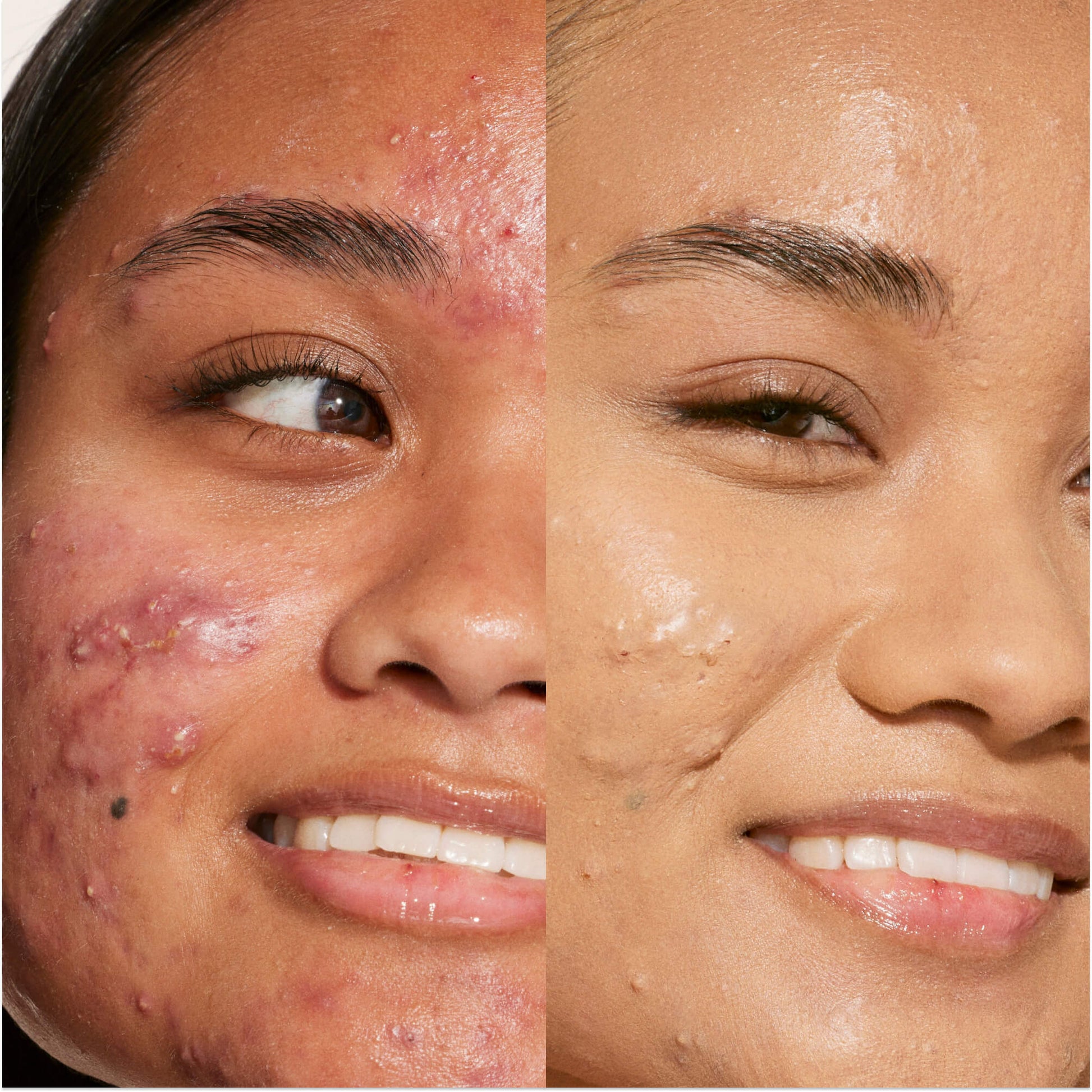 A person's face before and after using Tower 28 Beauty's Swipe Serum Concealer in shade 11.0 OC to cover up dark circles, blemishes, and discoloration