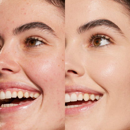 3.0 CC [A person's face before and after using Tower 28 Beauty's Swipe Serum Concealer in shade 3.0 CC to cover up dark circles, blemishes, and discoloration]