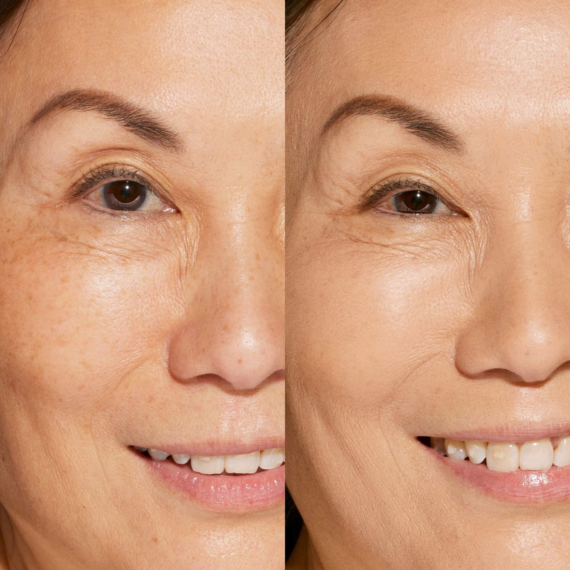 A person's face before and after using Tower 28 Beauty's Swipe Serum Concealer in shade 7.0 KTOWN to cover up dark circles, blemishes, and discoloration