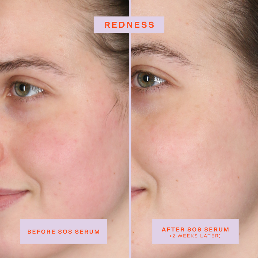 [Shared: Tower 28 Beauty SOS Rescue Serum Before + After Photo: left side of image (before) shows customer with redness on cheeks. Right side (after) of the image shows customer without redness on cheeks