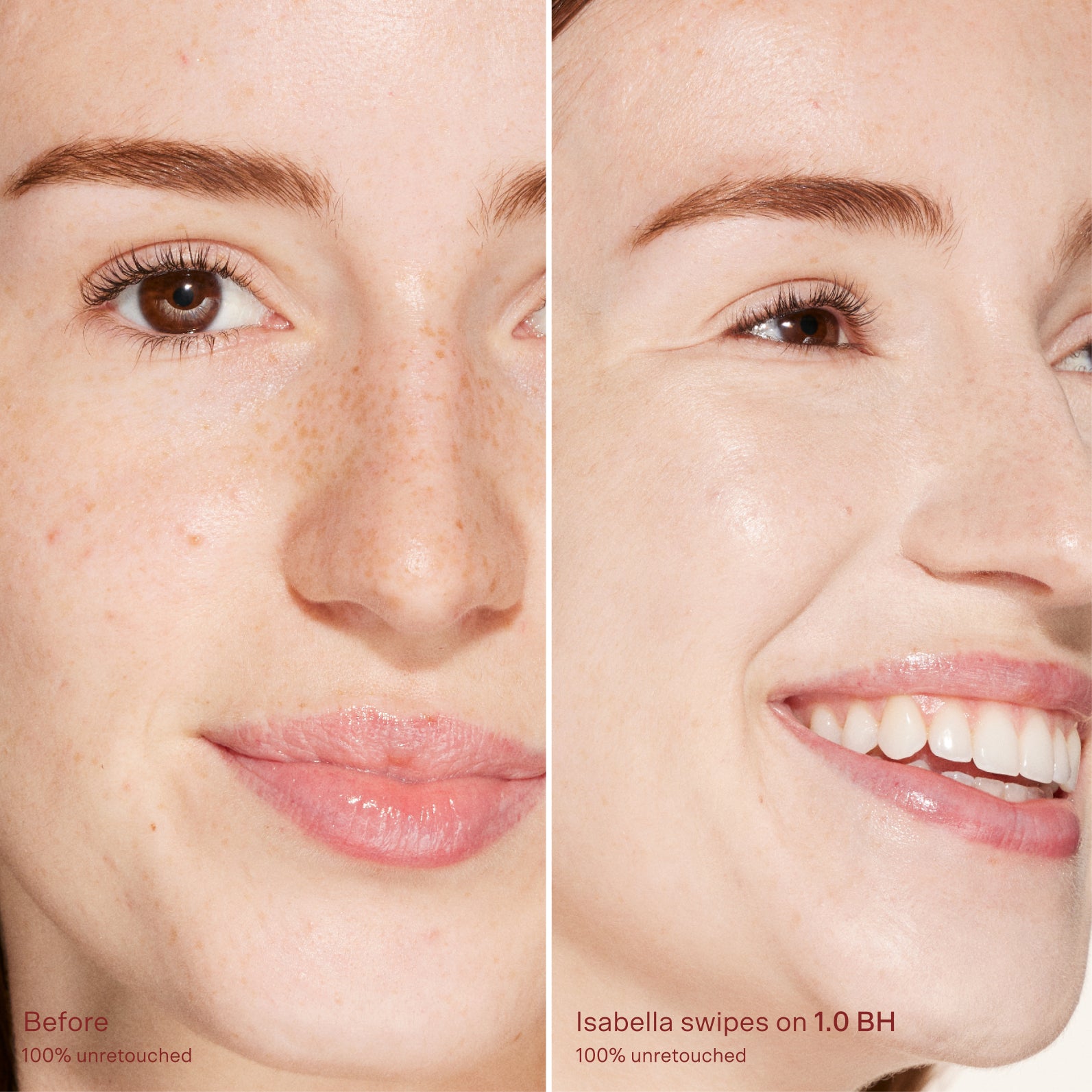 Before and after comparison of a woman's face with visible skin texture improvement. [1.0 BH]