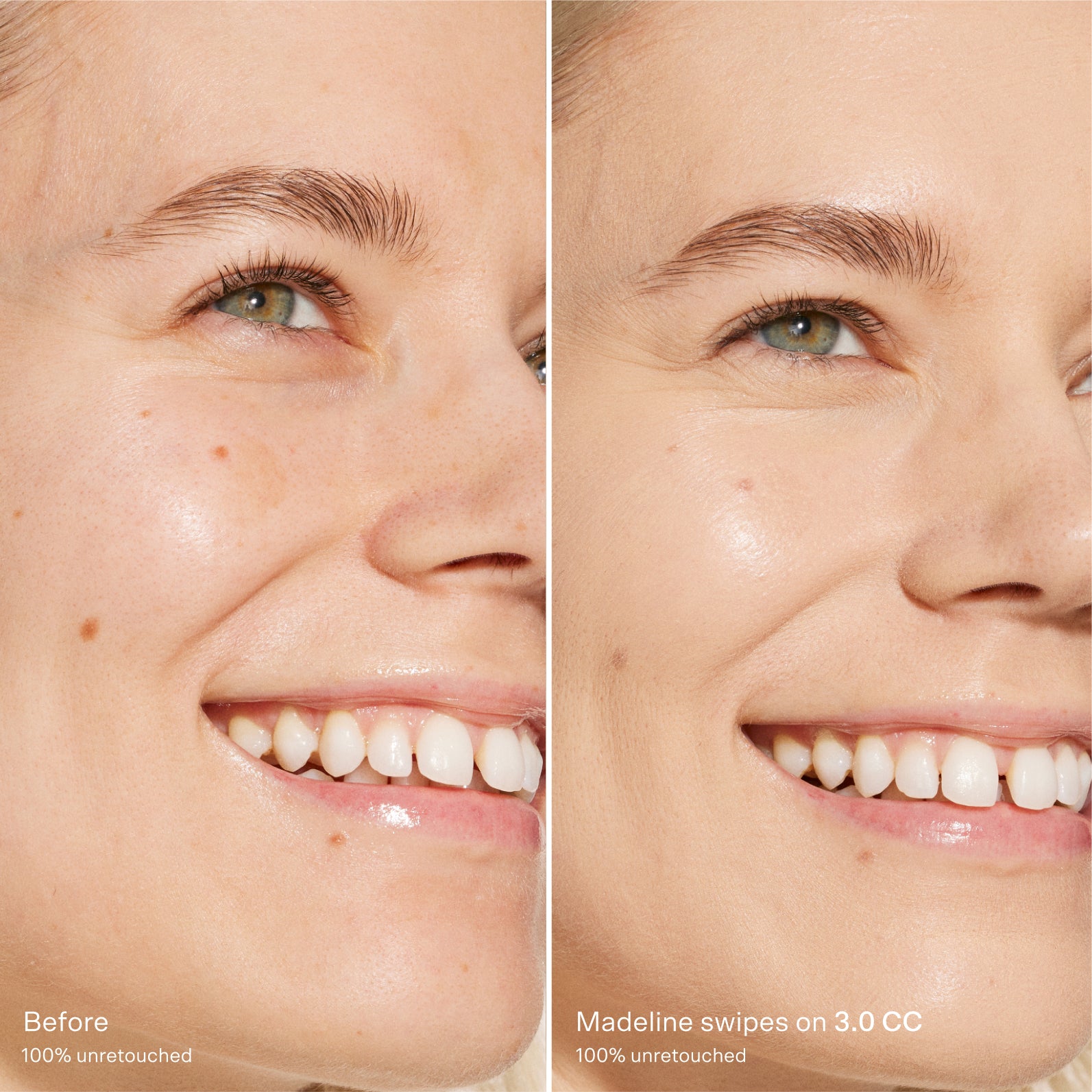 Before and after comparison of a woman's smile with skin treatment effects. [3.0 CC]