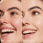 Before and after comparison of a woman's smile with skin treatment application. [3.0 CC]