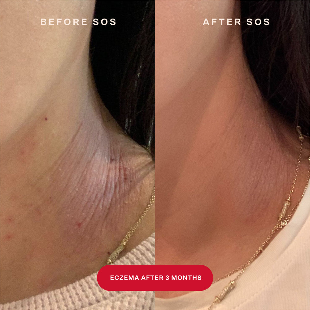 [Shared: A before and after image of a customer's neck showing the results of soothed skin after using SOS Rescue Spray for three months