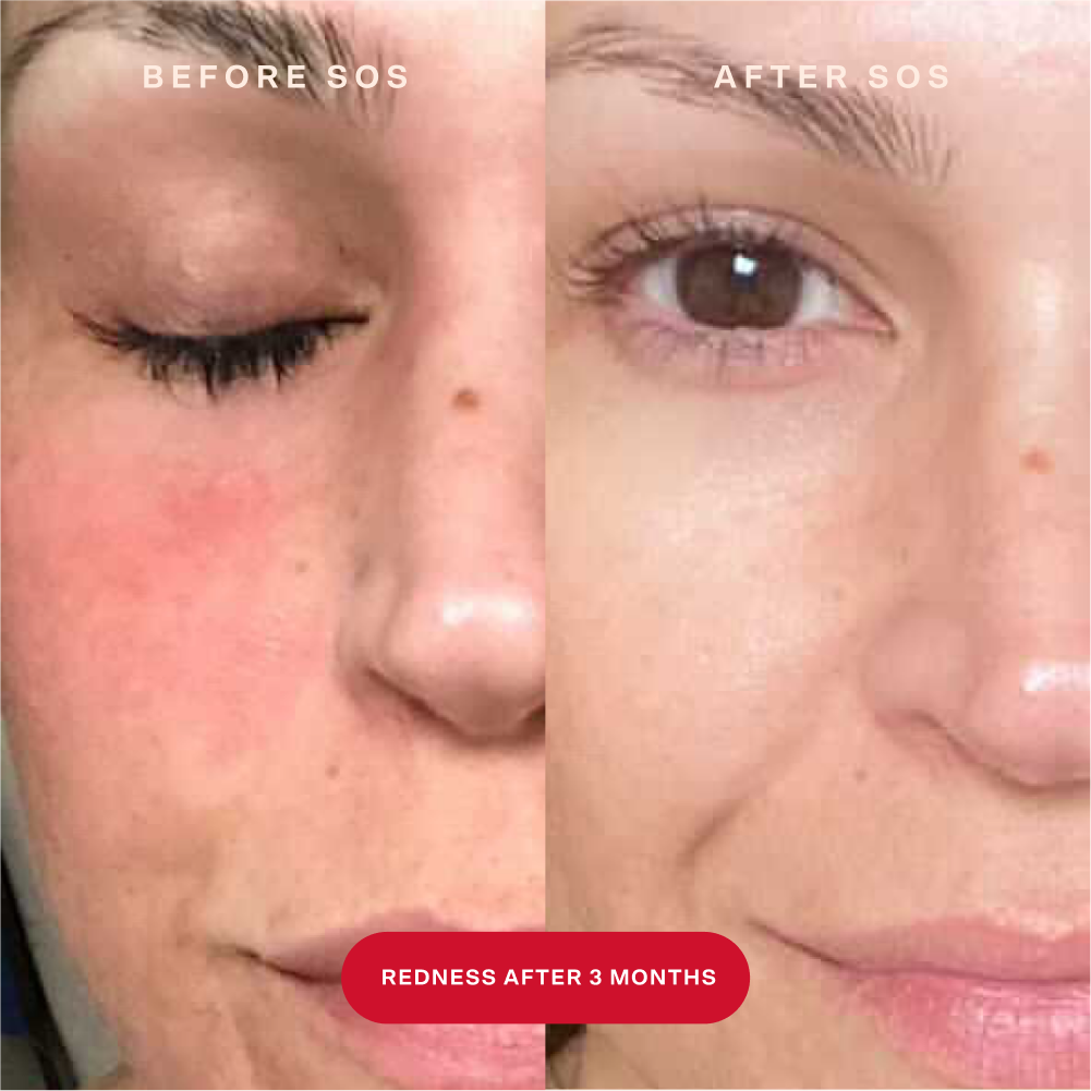 [Shared: A before and after image of a customer's face showing the results of reduced redness after using SOS Rescue Spray for three months