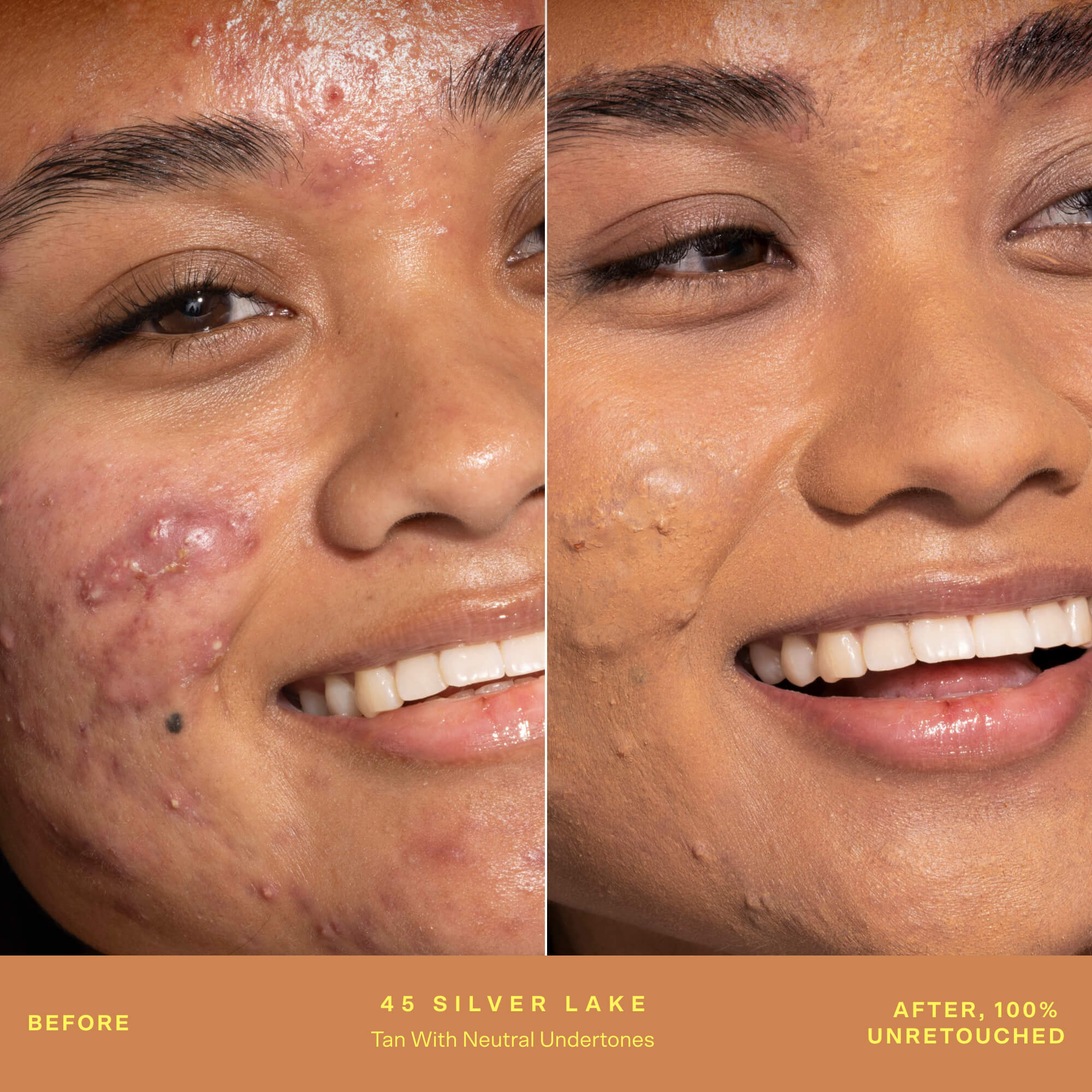 A person's face before and after applying SunnyDays™ Tinted SPF 30 in the shade 45 Silver Lake, revealing sheer, buildable coverage that visibly evens skin tone and softens discoloration while maintaining a natural, skin-like finish. [45 Silver Lake]