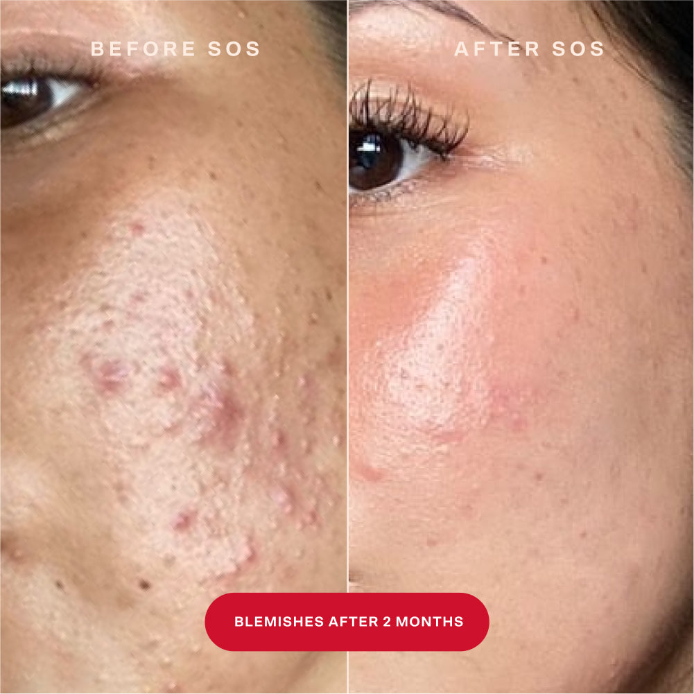 [Shared: A before and after image of a customer's cheek area showing the results of fewer blemishes after using SOS Rescue Spray for two months]