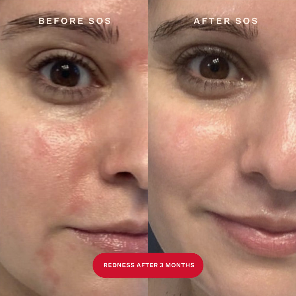 [Shared: A before and after image of a customer's face showing the results of reduced redness after using SOS Rescue Spray for three months
