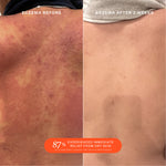 Tower 28 Beauty SOS Daily Rescue Facial Spray Before + After Photo: left side of image (before) shows customer with irritated eczema flare up on back. Right side (after) of the image shows customer's healed back with reduced eczema symptoms. [Shared]