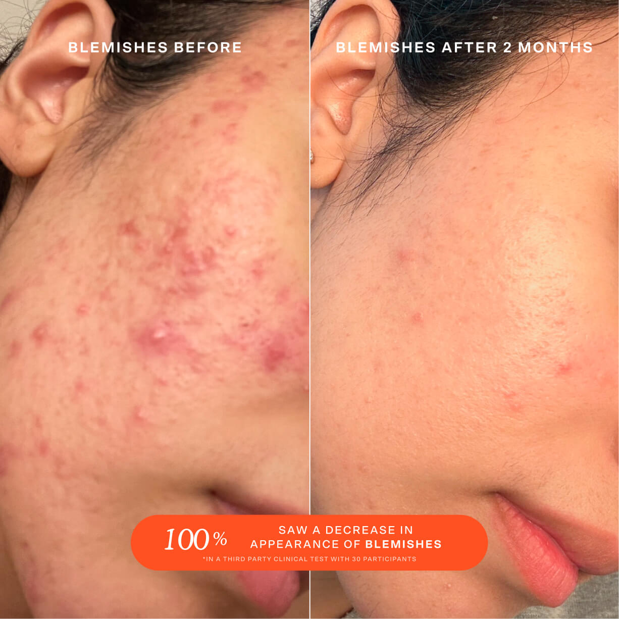 Tower 28 Beauty SOS Daily Rescue Facial Spray Before + After Photo: left side of image (before) shows customer with blemishes and inflammation on cheeks and jaw area. Right side (after) of the image shows customer with calmer, clearer skin and less visible irritation. [Shared]