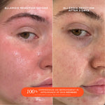 Tower 28 Beauty SOS Daily Rescue Facial Spray Before + After Photo: left side of image (before) shows customer with redness and patchiness on cheeks and chin. Right side (after) of the image shows customer with soothed, more even-toned skin and a healthy-looking glow. [Shared]