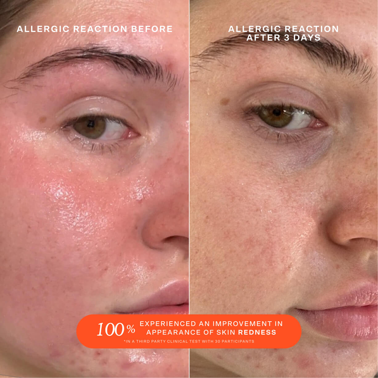 Tower 28 Beauty SOS Daily Rescue Facial Spray Before + After Photo: left side of image (before) shows customer with redness and patchiness on cheeks and chin. Right side (after) of the image shows customer with soothed, more even-toned skin and a healthy-looking glow. [Shared]