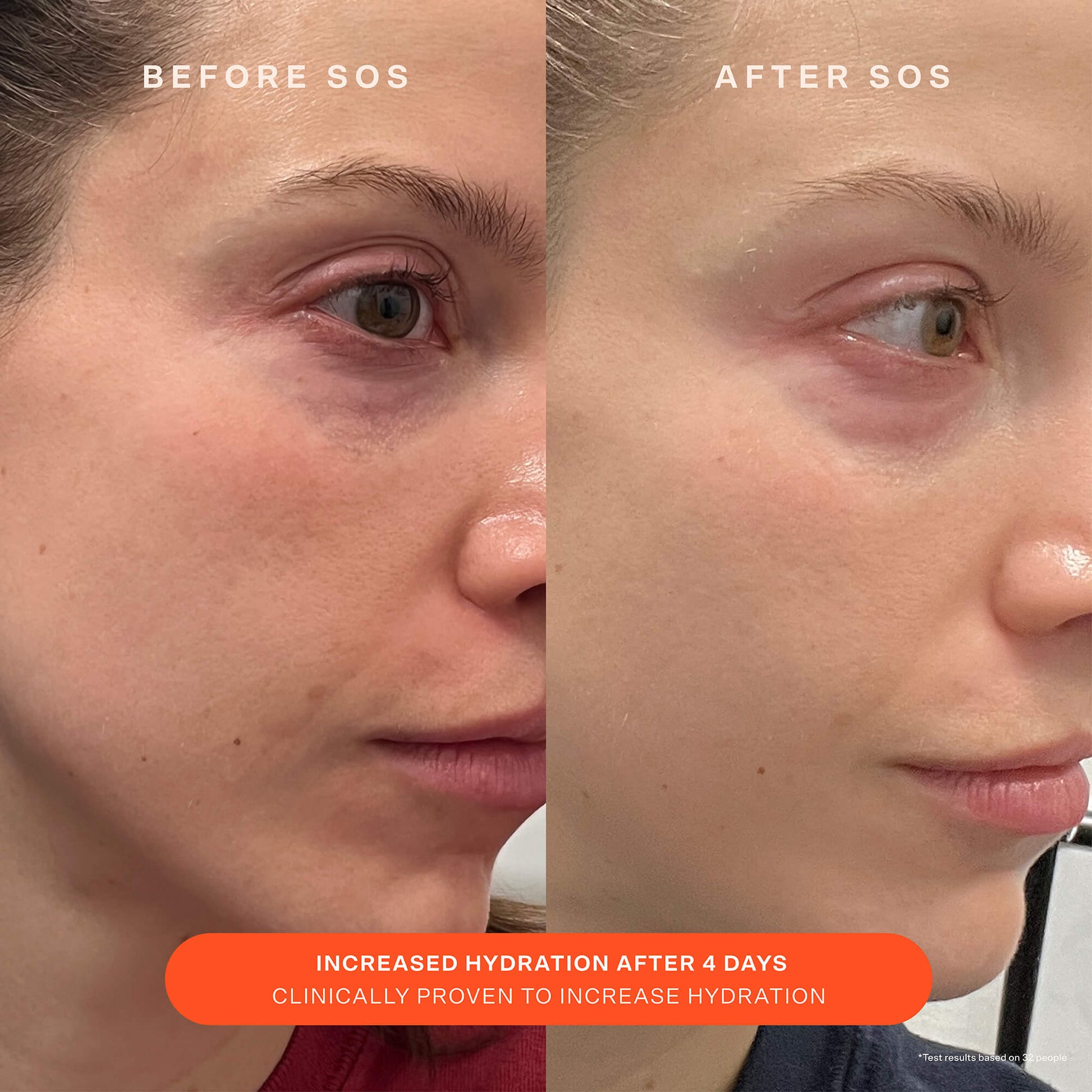 [Shared: A comparison before and after the use of Tower 28 Beauty SOS Recovery Cream. "Increased hydration after 4 days. Clinically proven to increase hydration."