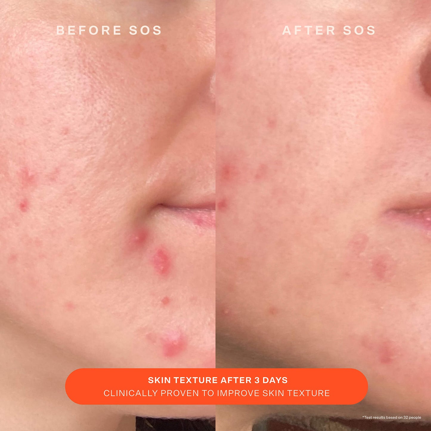 [Shared: A comparison before and after the use of Tower 28 Beauty SOS Recovery Cream. "Skin texture after 3 days. Clinically proven to improve skin texture"]