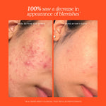 Before and after comparison of acne treatment with a clinical test result on an orange background. [Shared]