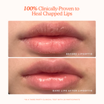 Before and after comparison of chapped lips using LipSoftie product. [LipSoftie™ Lip Treatment Trio]
