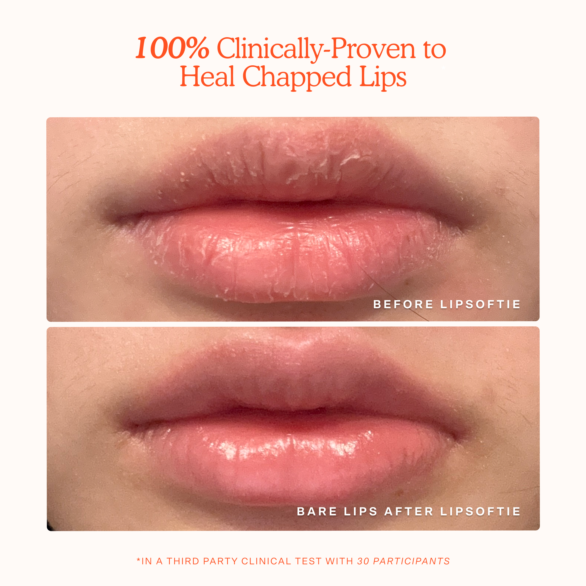 Before and after comparison of chapped lips using LipSoftie product. [LipSoftie™ Lip Treatment Trio]