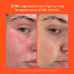 Before and after comparison of skin redness reduction with a spray product on an orange background. [Shared]