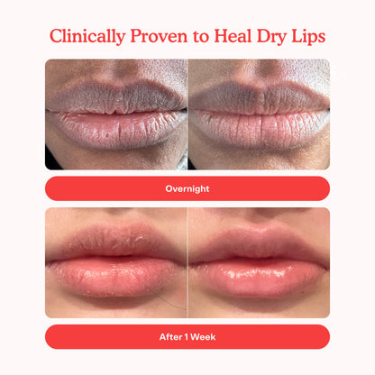[Shared: "Side-by-side before and after images showing improvement in dry, chapped lips. Top row labeled 'Overnight' shows visibly reduced dryness by the next day. Bottom row labeled 'After 1 Week' shows smooth, healthy lips with no visible peeling. Header text reads 'Clinically Proven to Heal Dry Lips.'"]
