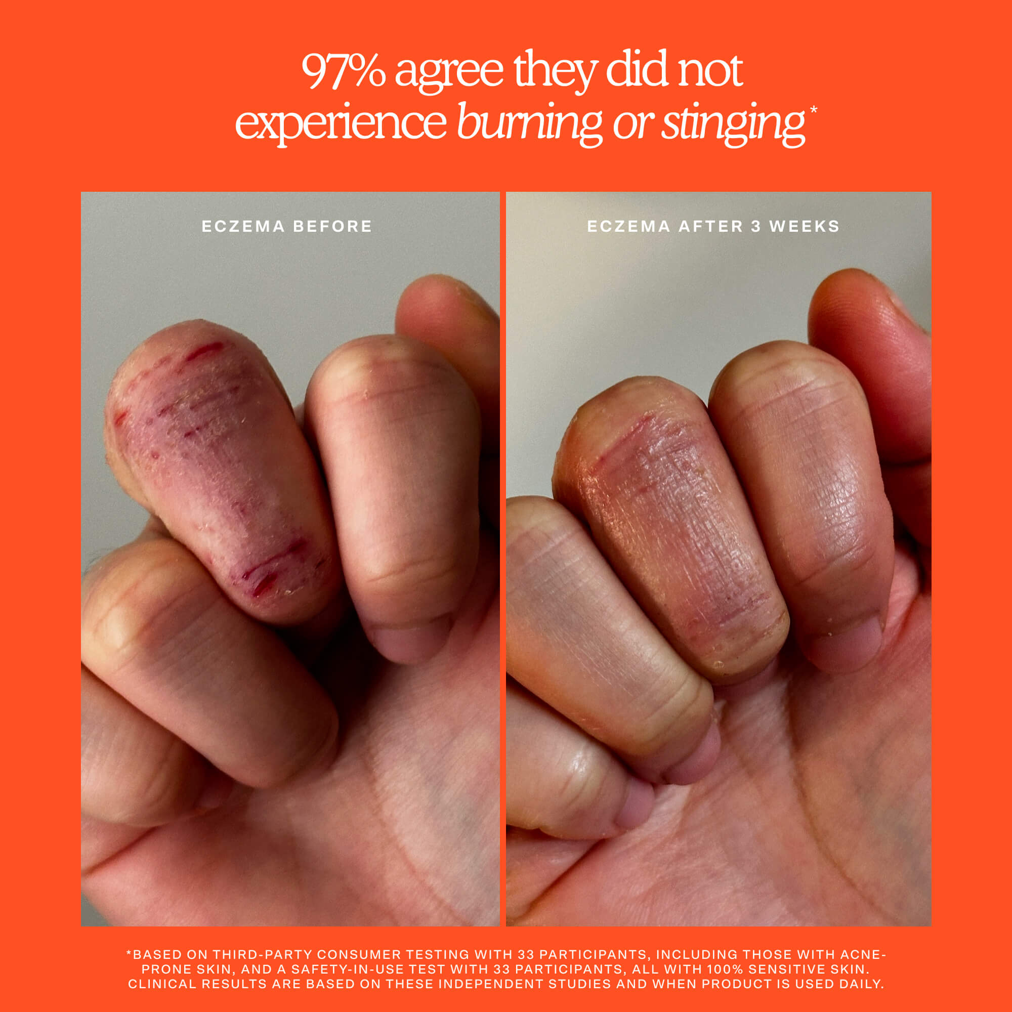 Before and after comparison of eczema on a hand with an orange border and text. [Shared]