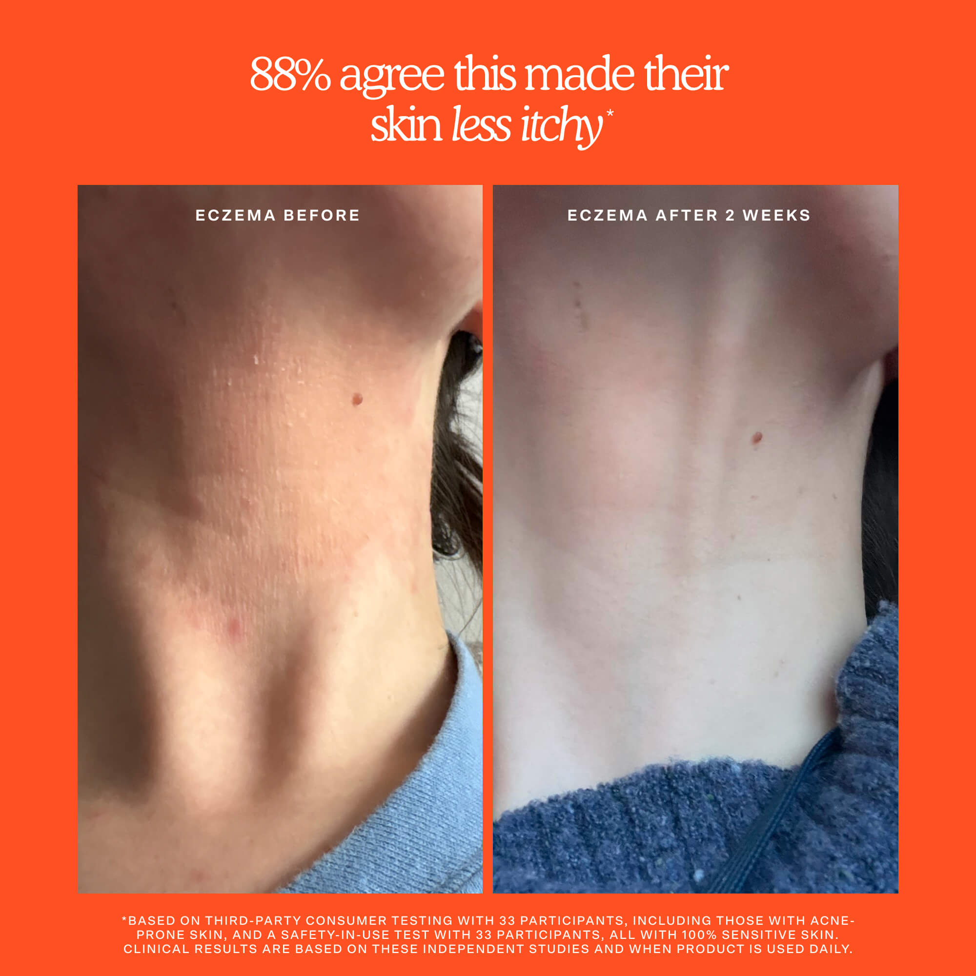 Before and after comparison of eczema on skin with text indicating  improvement. [Shared]