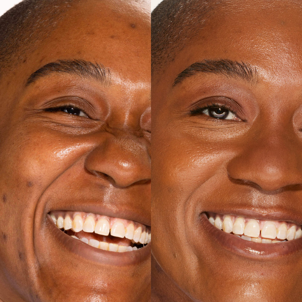 A person's face before and after using Tower 28 Beauty's Swipe Serum Concealer in shade 18.0 SGV to cover up dark circles, blemishes, and discoloration