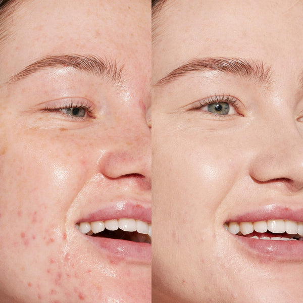 A person’s face before and after using Tower 28 Beauty's Swipe Serum Concealer in shade 2.0 BU to visibly reduce redness, acne, and even out skin tone. [2.0 BU]