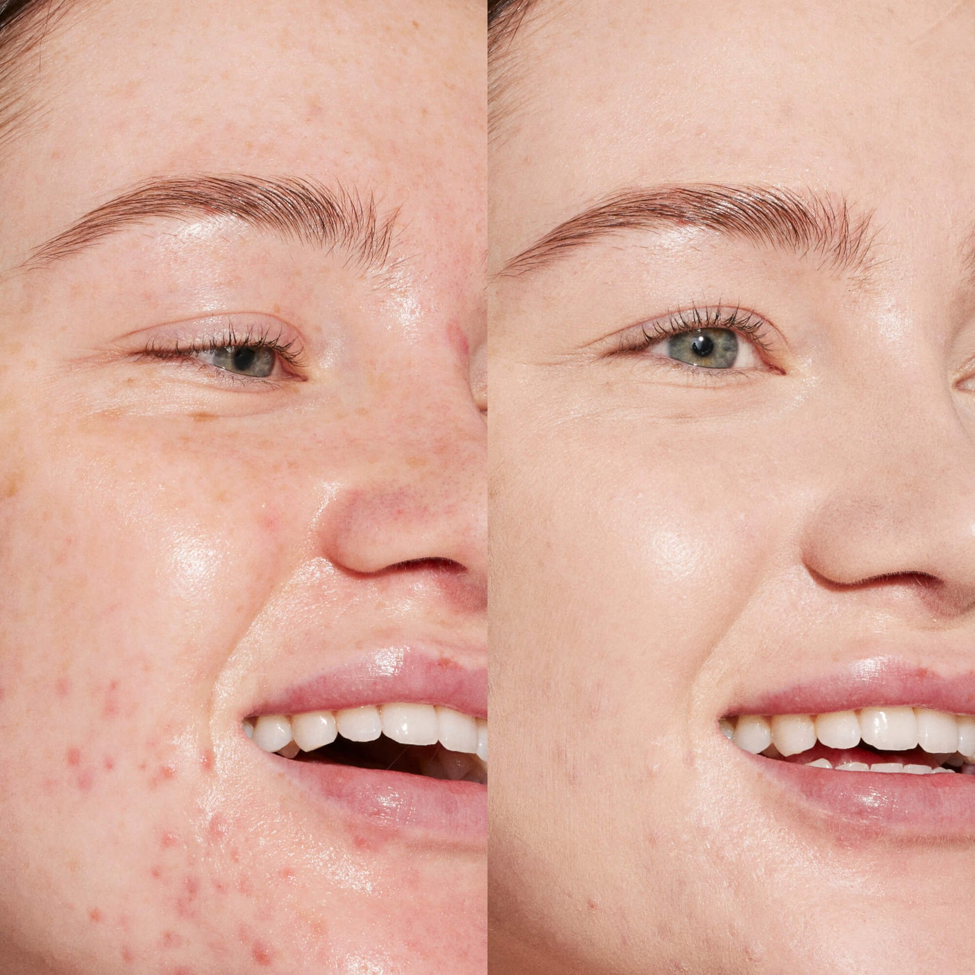 A person's face before and after using Tower 28 Beauty's Swipe Serum Concealer in shade 2.0 BU to cover up dark circles, blemishes, and discoloration