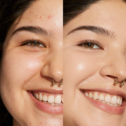 4.0 DTLA [A person's face before and after using Tower 28 Beauty's Swipe Serum Concealer in shade 4.0 DTLA to cover up dark circles, blemishes, and discoloration]