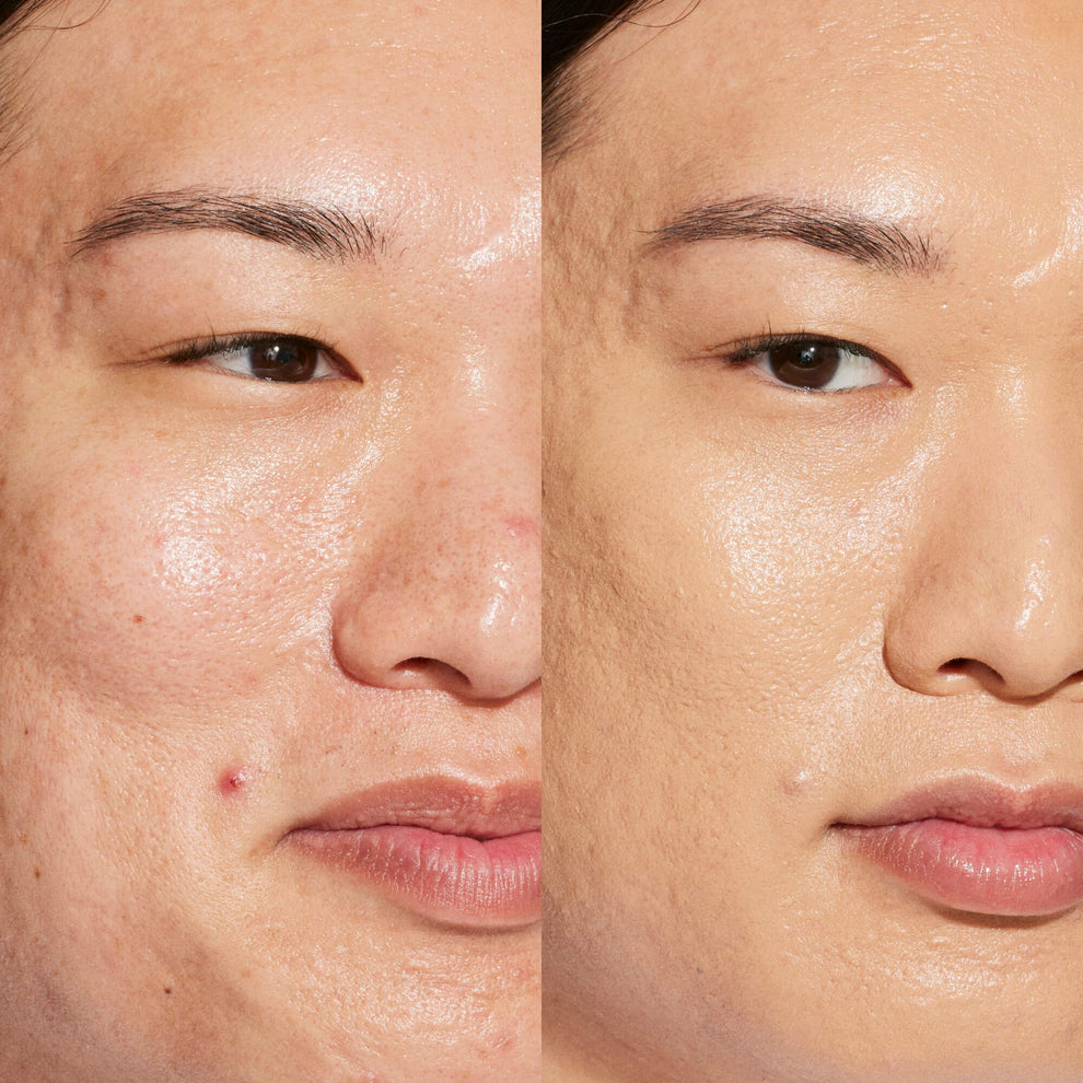 A person's face before and after using Tower 28 Beauty's Swipe Serum Concealer in shade 9.0 MDR to cover up dark circles, blemishes, and discoloration