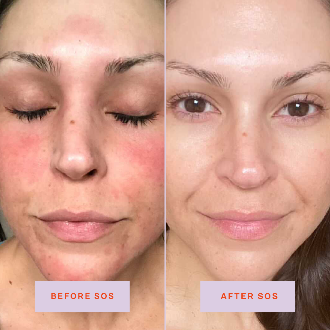 [Shared: Tower 28 Beauty SOS Daily Rescue Facial Spray Before + After Photo: left side of image (before) shows customer with redness on cheeks, forehead, and chin. Right side (after) of the image shows customer without redness on cheeks, forehead, and chin.