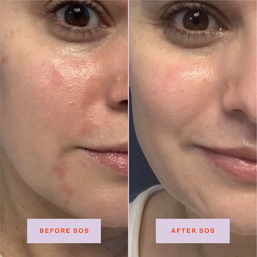 [Shared: Tower 28 Beauty SOS Daily Rescue Facial Spray Before + After Photo: left side of image (before) shows customer with redness and patchiness on cheeks and chin. Right side (after) of the image shows customer without redness or patchiness on cheeks and chin.