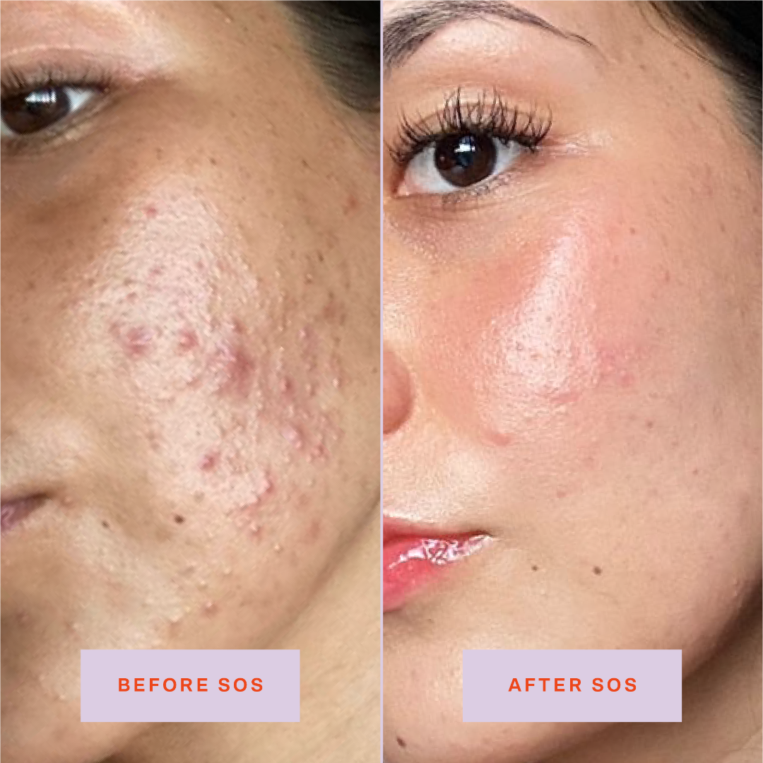 [Shared: Tower 28 Beauty SOS Daily Rescue Facial Spray Before + After Photo: left side of image (before) shows customer with blemishes and inflammation on cheeks and jaw area. Right side (after) of the image shows customer with reduced blemishes and inflammation on cheeks and jaw area.