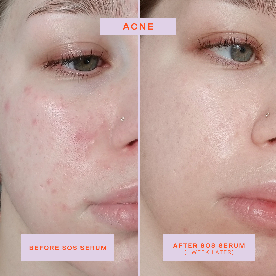 [Shared: Tower 28 Beauty SOS Rescue Serum Before + After Photo: left side of image (before) shows customer with acne on cheeks. Right side (after) of the image shows customer without acne on cheeks]