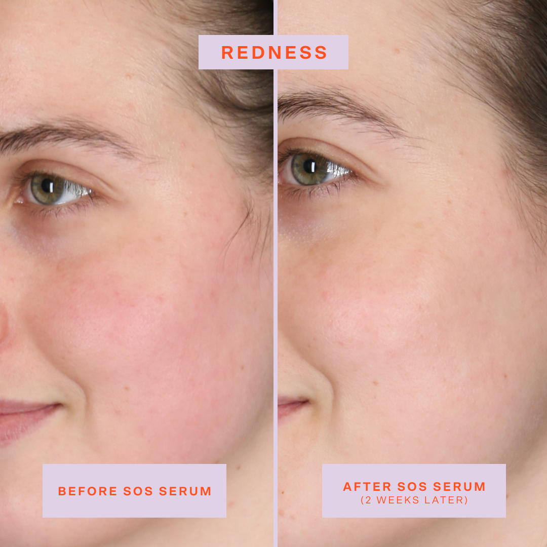 [Shared: Tower 28 Beauty SOS Rescue Serum Before + After Photo: left side of image (before) shows customer with redness on cheeks. Right side (after) of the image shows customer without redness on cheeks]