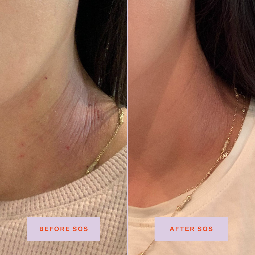[Shared: Tower 28 Beauty SOS Daily Rescue Facial Spray Before + After Photo: left side of image (before) shows customer with irritated eczema flare-up on neck. Right side (after) of the image shows customer's healed neck area with reduced eczema symptoms.