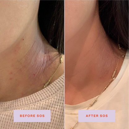 [Shared: Tower 28 Beauty SOS Daily Rescue Facial Spray Before + After Photo: left side of image (before) shows customer with irritated eczema flare-up on neck. Right side (after) of the image shows customer's healed neck area with reduced eczema symptoms.]